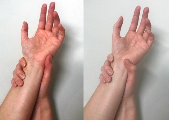 Showing-carpal-tunnel-syndrome-specialised-hand-therapy.jpg