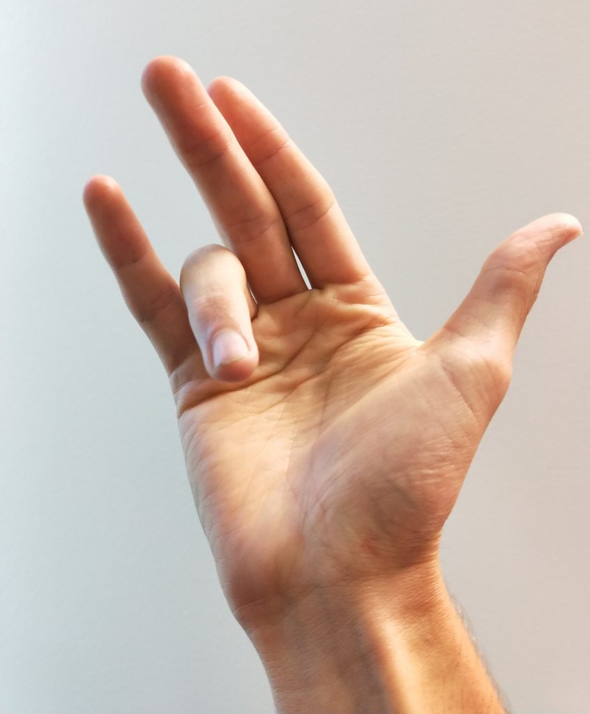 Trigger Finger or Trigger Thumb: Otherwise Known as Stenosing Tenosynovitis  - Premier Physical Therapy
