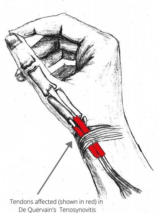 De Quervains Tendinosis Symptoms And Treatment Orthoinfo Aaos Images